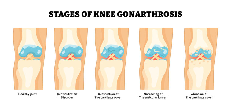 Stages of knee Gonarthrosis stages development process for medical poster, Knee Joint Osteoarthritis. Labeled joint nutrition disorder, cartilage cover abrasion destruction, articular lumen narrowing.