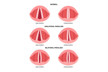 Vocal cords paralysis