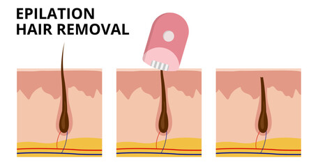 Electric epilator removing hair from underneath skin surface