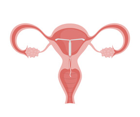 Intrauterine device placed in female uterus, ovaries and fallopian tubes visible