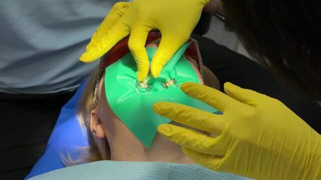 Dentist's hands in gloves with dental punch and cofferdam scarf. Dentist treats woman's tooth to patient with rubber dam. Modern dental office. Treatment elimination of caries, installation of filling