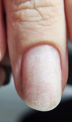 Cracked fingernail close-up, texture vividly resembles arid desert landscape, symbolizing...
