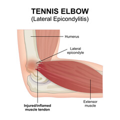 Tennis Elbow (Lateral Epicondylitis) flashcard illustration