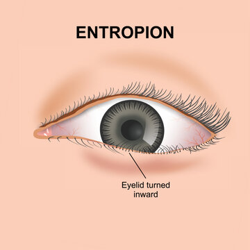 Entropion eye flashcard medical illustration