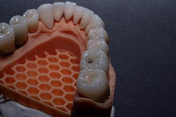 Total prosthetics. Zirconia teeth with transparent edge on a lower jaw model on a black background
