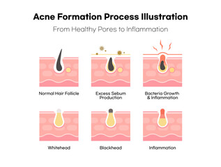 An Illustration of the Acne Formation Process from Healthy Pores to Inflammation.