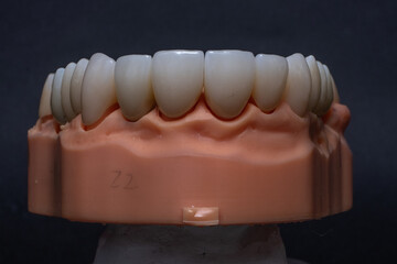 Total prosthetics. zirconium crowns with transparent edge on a upper jaw model. Porcelain crowns for front teeth. © Алена Пахомова