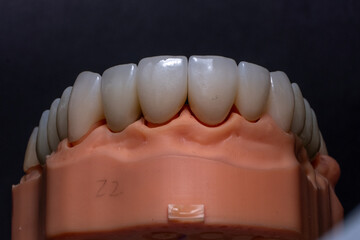 Total prosthetics. Zirconia teeth with transparent edge on a upper jaw model in aesthetic dentistry. Porcelain crowns for front teeth. © Алена Пахомова