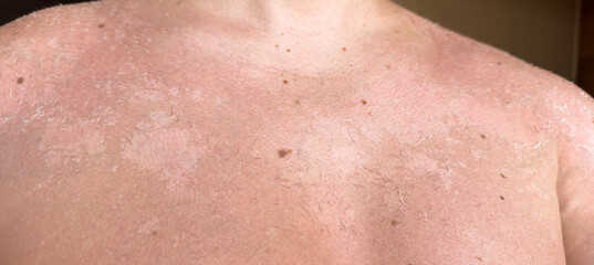 Sunburn, peeling skin, burns, skin problem, vertigo, health, summer and sun. High quality
