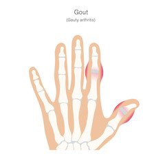 Gout, or inflamatory arthritis of hand fingers.