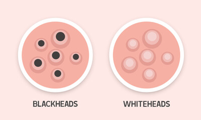 Blackheads and whiteheads. Types of acne. Vector illustration