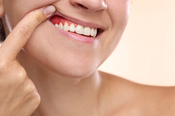 Fototapeta premium Woman showing inflamed gum on beige background, closeup