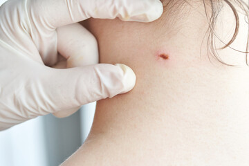 Close-up of skin examination on caucasian female neck by gloved hands highlighting mole.
