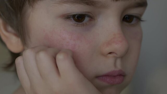 Boy Has Dry Red Skin and Scratching Her Face. Child Scratches Atopic Skin. Dermatitis, Diathesis, Allergy on Child Body and Face. Irritation and Pruritus. Boy Having Allergic Reaction on Skin to Food.