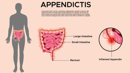 Appendicitis Medical Concept Human Digestive System with Inflamed Appendix Illustration