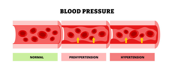 Blood pressure levels diagram showing normal or healthy, prehypertension, hypertension stages within blood vessels structure. Medical science healthcare treatment. Cardiovascular heart illustration.
