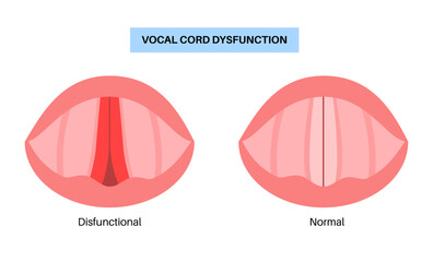 Vocal cords dysfunction