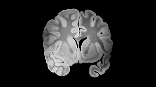 Alzheimer brain compared to healthy hemisphere in coronal view, highlighting cortical atrophy, ventricular enlargement, and neurodegeneration changes.