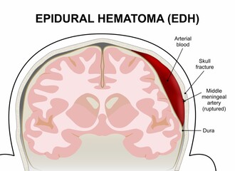 Epidural Hematoma (EDH) brain flashcard medical illustration