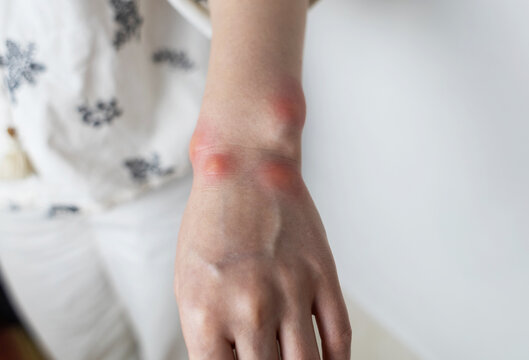 Close up of a swollen wrist with visible redness, inflammation, caused by an insect bite or allergic reaction. The hand signs of rash, itching, and local pain, typical of mosquito bites, bee stings