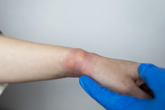 Close up of a swollen wrist with visible redness, inflammation, caused by an insect bite or allergic reaction. The hand signs of rash, itching, and local pain, typical of mosquito bites, bee stings