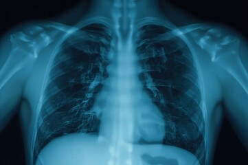 Chest radiograph for assessing pulmonary health in children