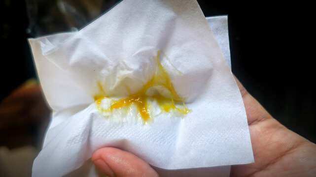 Concern over thick, yellow mucus on a tissue, highlighting respiratory health issues, a hand holding a tissue with evidence of nasal discharge