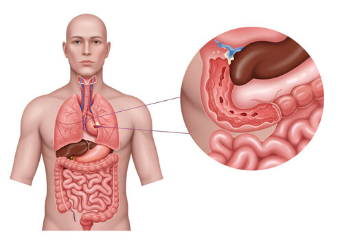 Human anatomy illustration highlighting the stomach and digestive system, with a detailed close-up of the stomach's interior.