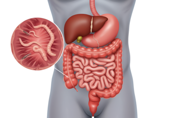 Illustration of the human digestive system with a magnified view of intestinal worms.