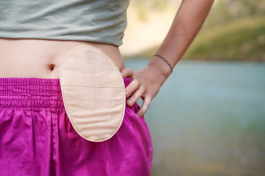 Closeup of a Ostomy bag outdoors