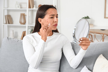 Young woman ill with chickenpox and mirror smearing spots at home