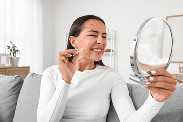 Young woman ill with chickenpox and mirror smearing spots at home