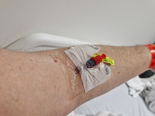 Cannula in arm