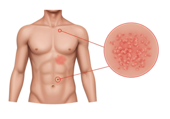 Medical illustration showing torso with skin rash and magnified view of affected area.
