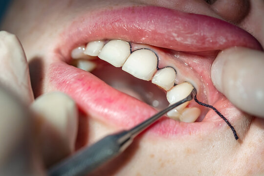 Close-up of dentist inserting gingival retraction cord under the gum before digital impression scanning. Concept of precision dentistry and prosthetic preparation.