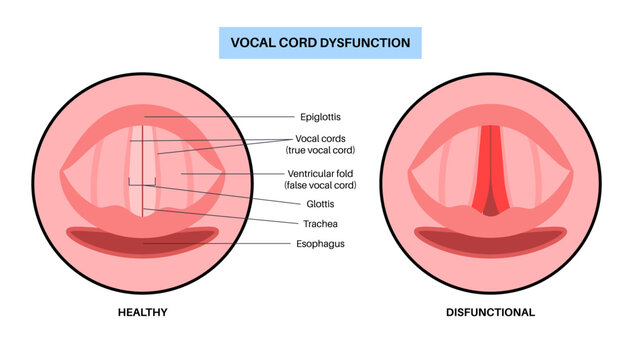 Vocal cords dysfunction