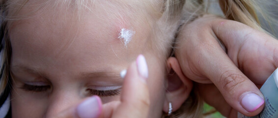 Applying Cream to Child Forehead Insect Bite