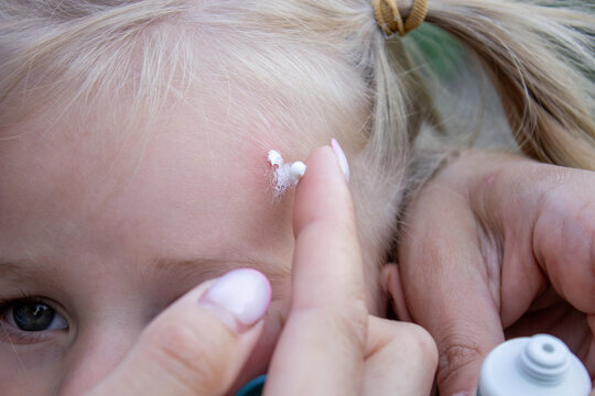 Applying Cream to Child Forehead Insect Bite