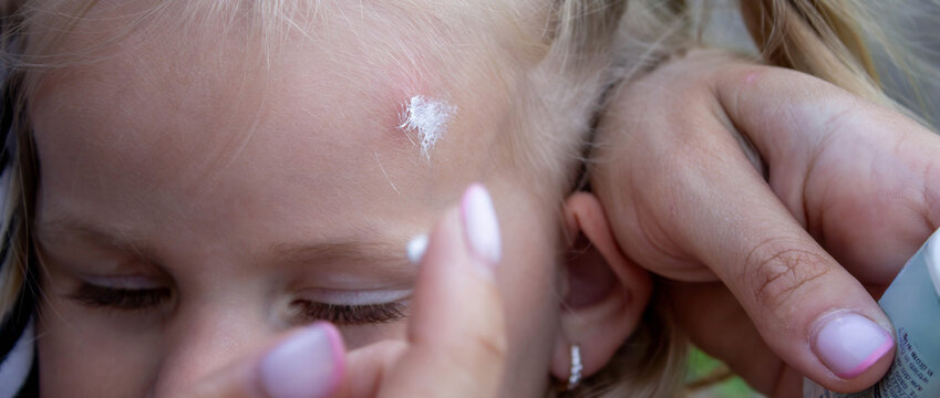 Applying Cream to Child Forehead Insect Bite