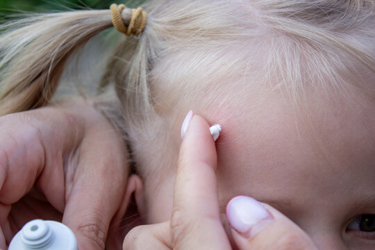 Applying Cream to Child Forehead Insect Bite