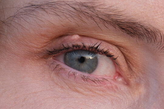 stye on the upper eyelid
