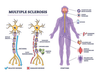 Multiple sclerosis overview showing neuron damage, immune cells, and main symptoms in a clear outline diagram. Outline diagram