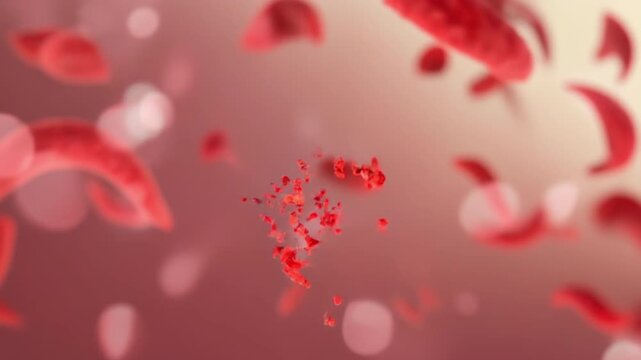 3D Animation of Microscopic View of Sickle Cell Being Destroyed - Medical illustration Footage. 4K