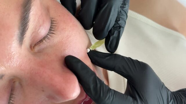 Face lifting PDO Suture operation. innovative technique of New thread lift, cosmetologist preparing to do procedure to female client, select the appropriate thread option