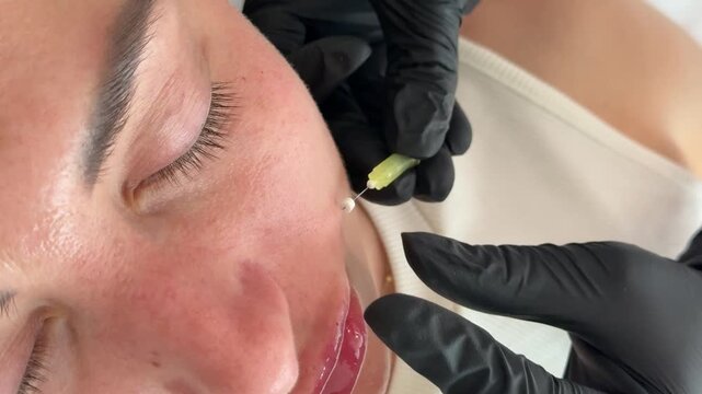 Face lifting PDO Suture operation. innovative technique of New thread lift, cosmetologist preparing to do procedure to female client, select the appropriate thread option