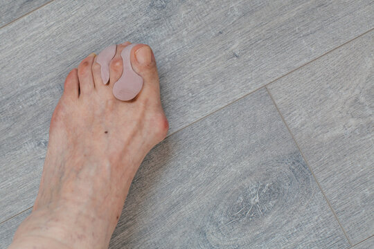 Top view of a deformed foot with hallux valgus wearing a soft orthopedic toe separator on a wooden floor, concept of health and podiatric care, copyspace