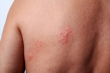 shingles outbreak on the upper back of a man