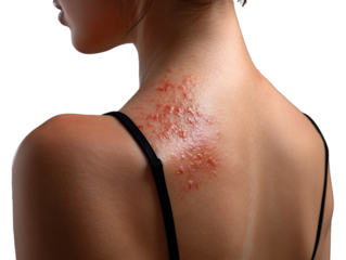Skin Irritation: A close-up depiction of a skin rash on the back and shoulder of a woman, highlighting the physical impact of skin irritation or an allergic reaction.