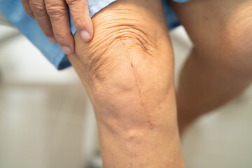 Asian elderly woman patient show her scars surgical total knee joint replacement Suture wound surgery arthroplasty.