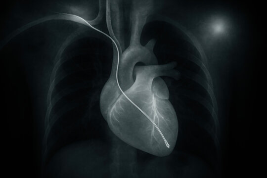 X-Ray of a Heart with Catheter - Medical Procedure Illustration
